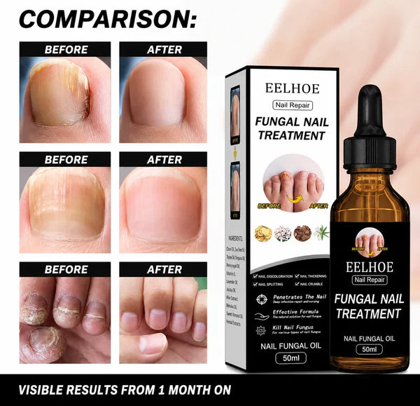 Fungal Nail Treatment Oil
